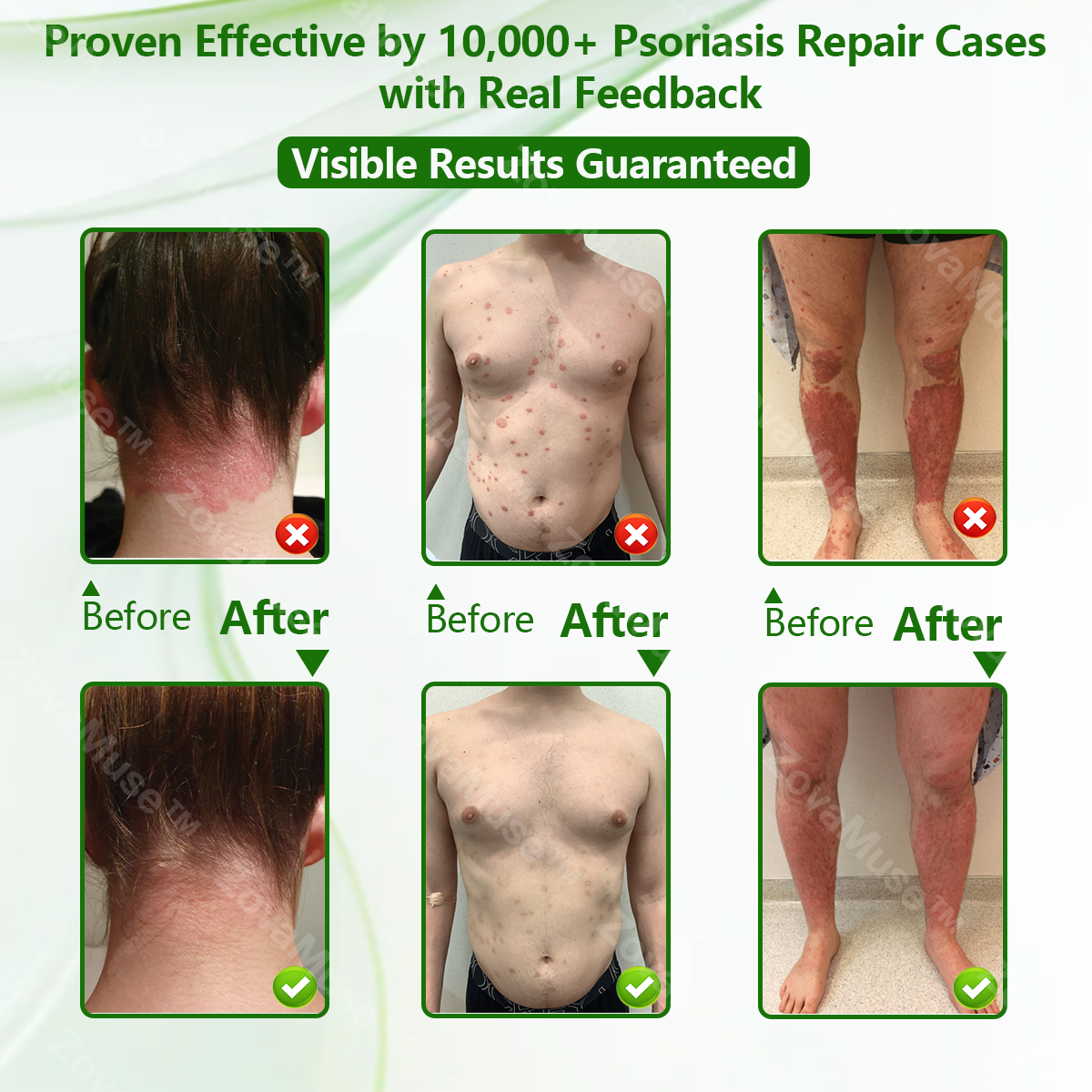 🌿 Herbal Psoriasis Repair Balm 🌸 Deep Relief for Stubborn, Flaky Skin