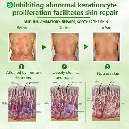 🌿 Herbal Psoriasis Repair Balm 🌸 Deep Relief for Stubborn, Flaky Skin